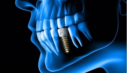 השתלות שיניים - תמונת המחשה